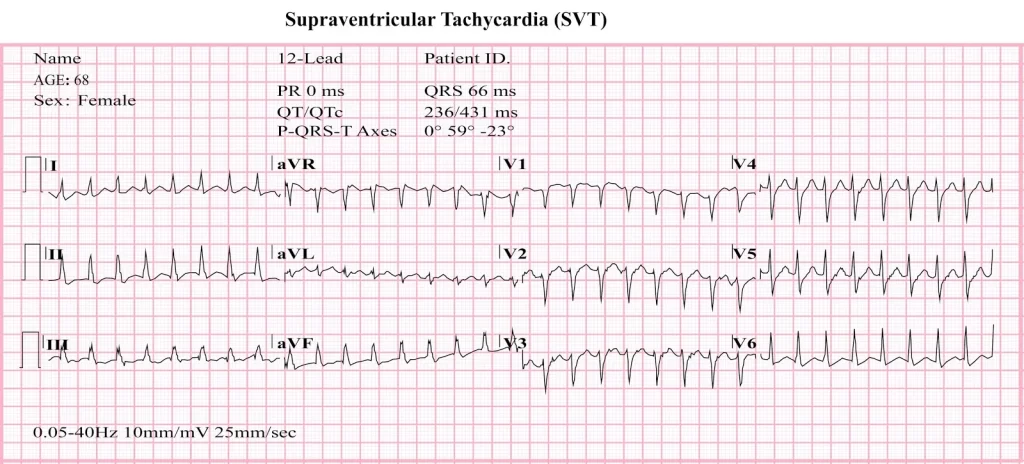 Supraventricular-tachycardia