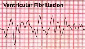 Ventricular-fibrillation