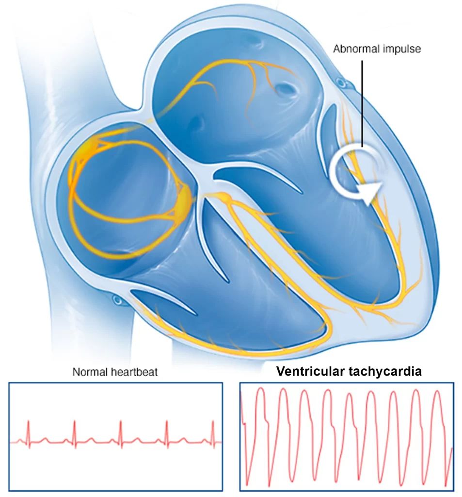Ventricular-tachycardia