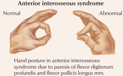 Anterior Interosseous Nerve Syndrome