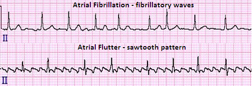 atrial-fibrillation-and-flutter