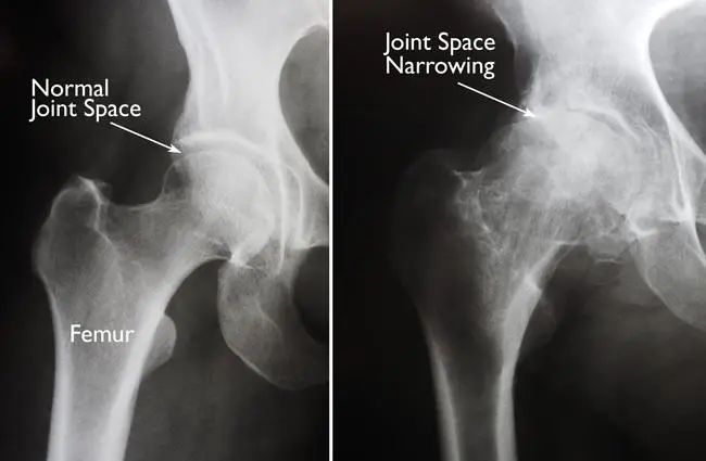 hip-joint-x-rays