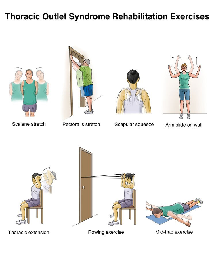 Exercise for thoracic outlet syndrome