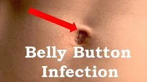 Will a Belly Button Infection Go Away On Its Own?