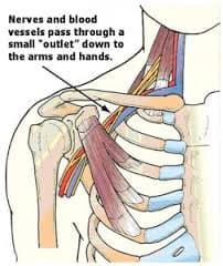 Costoclavicular Syndrome
