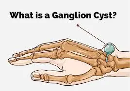 Ganglion-cyst