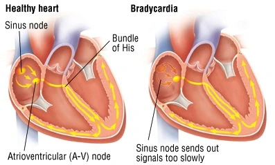 Healthy-heart-and-bradycardia