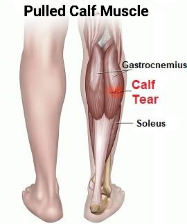 Pulled Calf Muscle