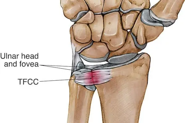 Triangular Fibrocartilage Complex(TFCC) Injury