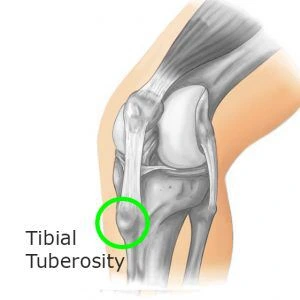 Tuberosity of the Tibia