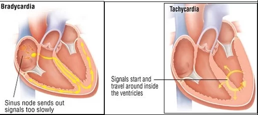 Tachycardia-And-Bradycardia