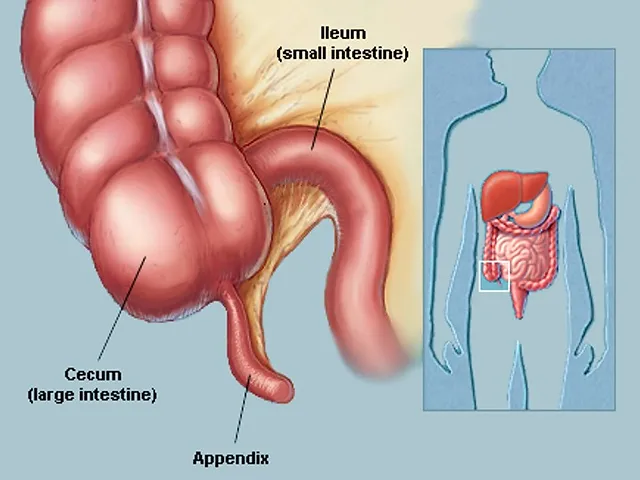 appendicits