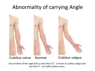Carrying Angle of The Elbow