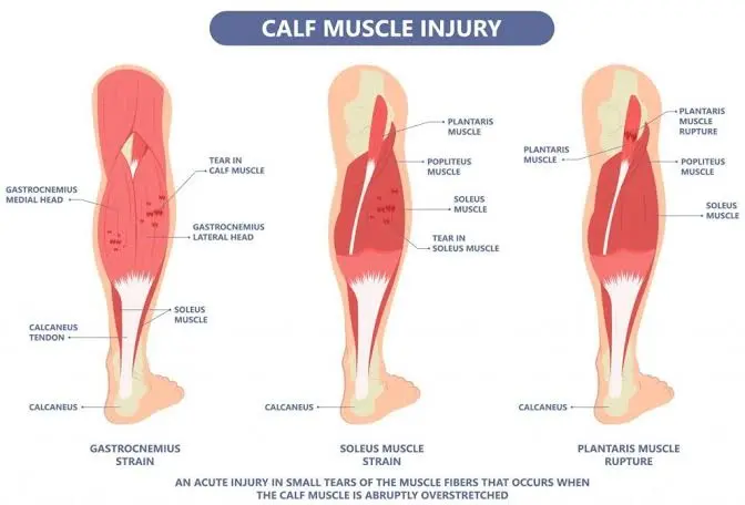 deferent calf muscle injury
