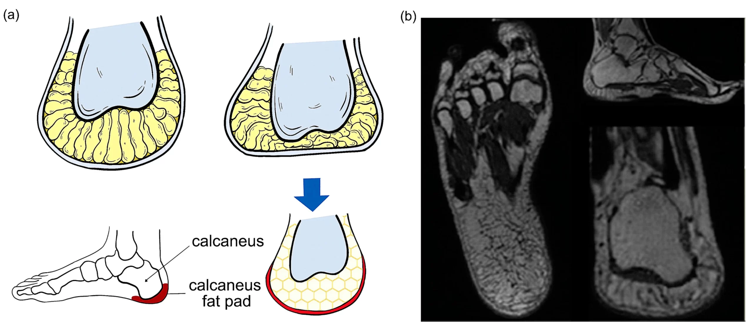 Heel Fat Pad Syndrome
