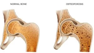 osteoporosis of joint