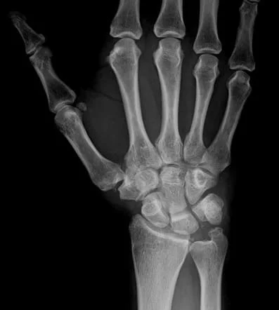 Ulnar Styloid Impaction Syndrome