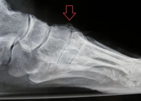 x-ray-of-midfoot-exostosis