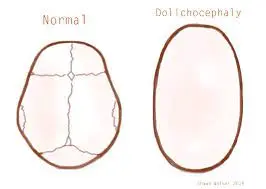 Dolichocyphely-head-shape