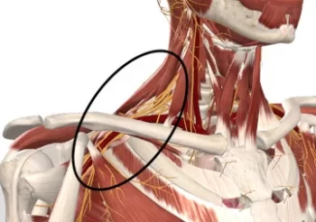 Pectoralis Minor Syndrome