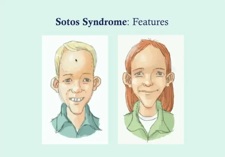 Sotos-syndrome-features