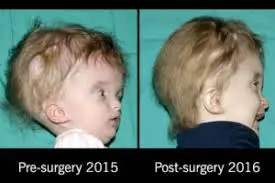 Surgery-for-macrocephaly