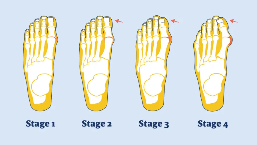 stages-of-bunions