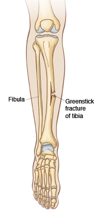 Greenstick-fracture