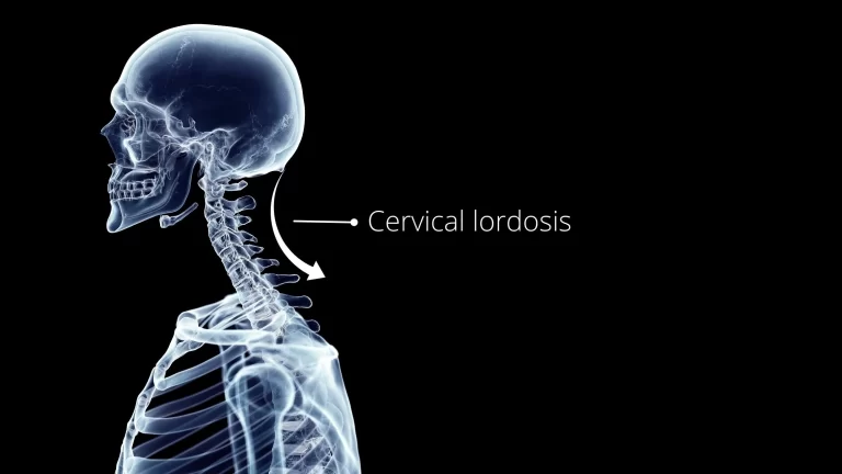Cervical Lordosis