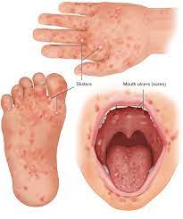 hand , foot, mouth disease