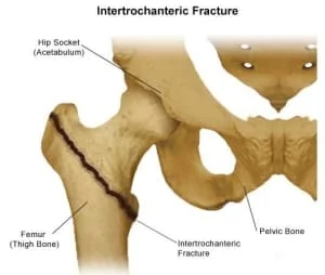 Intertrochanteric Fracture