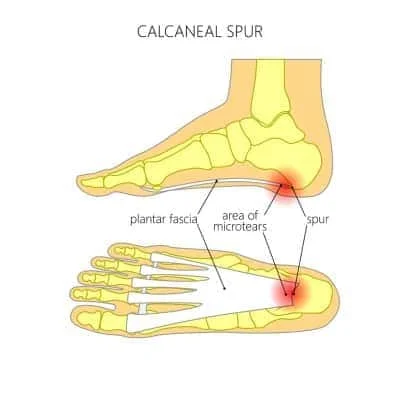 Calcaneal spur