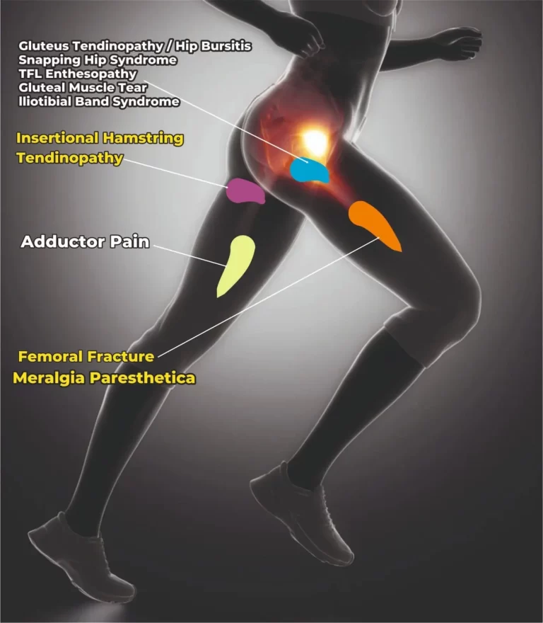 Front Side of the Hip Pain Location Diagram