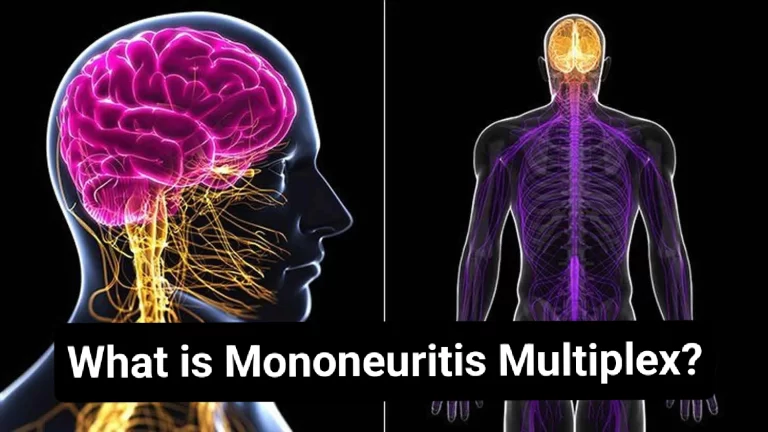 Mononeuritis Multiplex