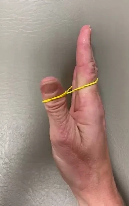 Rubber Band Abduction