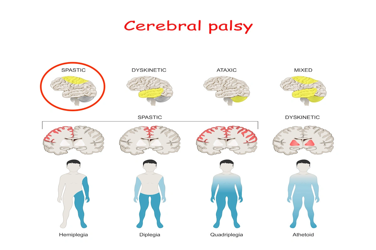 Spastic-Cerebral-Palsy-Quadriplegic
