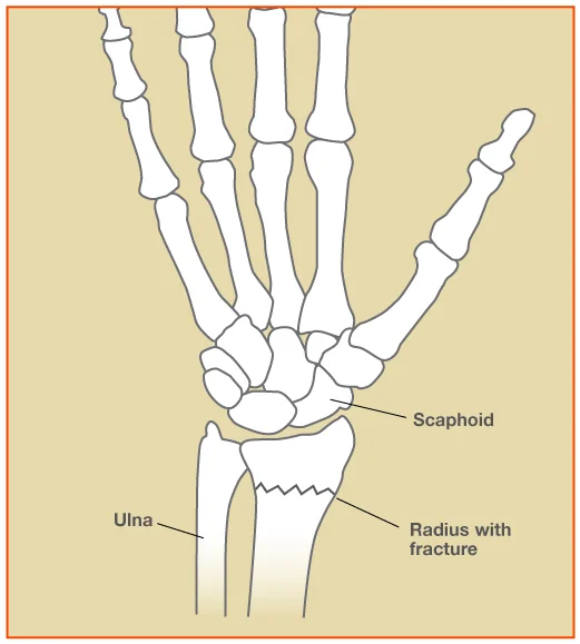 Radius Bone Fracture