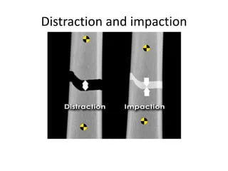 Distraction and Impaction Of Bone