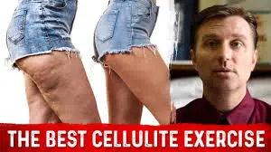 Exercises for leg Cellulitis