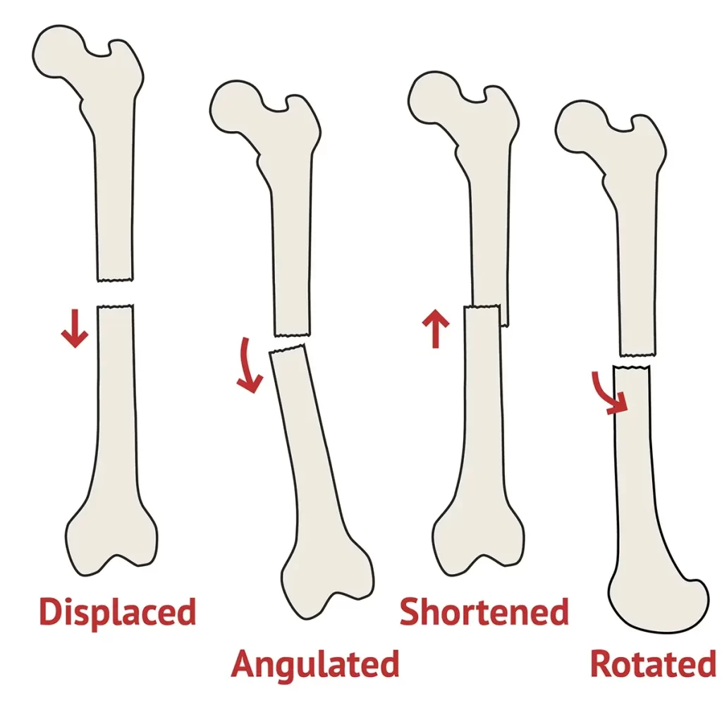 Fracture Displacement Of Bone
