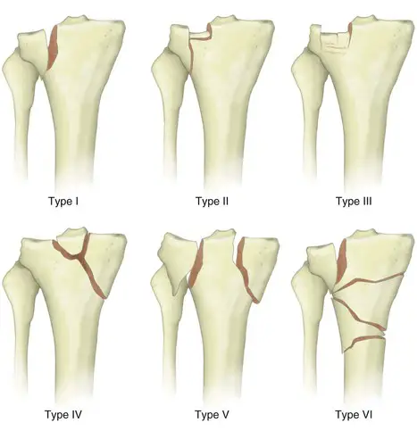 Fracture of the Lateral Tibial Plateau