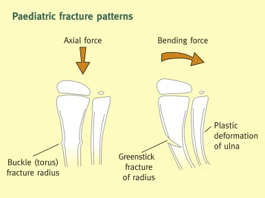 Greenstick-and-buckle-fracture