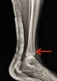 HAIRLINE FRACTURE OF THE ANKEL