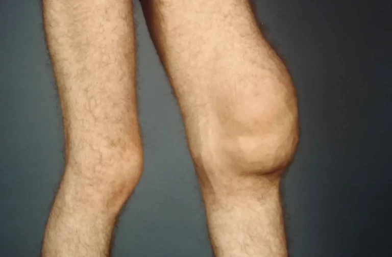 Knee Joint Effusion