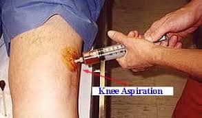 Knee Arthrocentesis