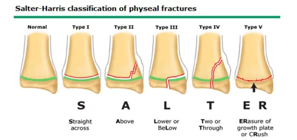 Salter-Harris Type Fractures