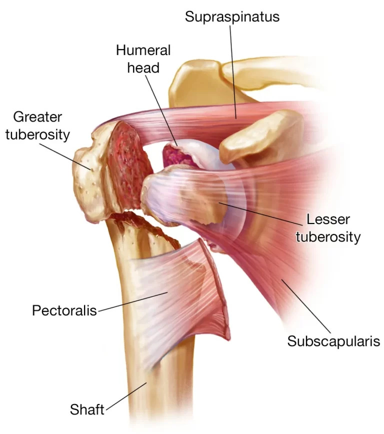 Bone Fracture in Shoulder