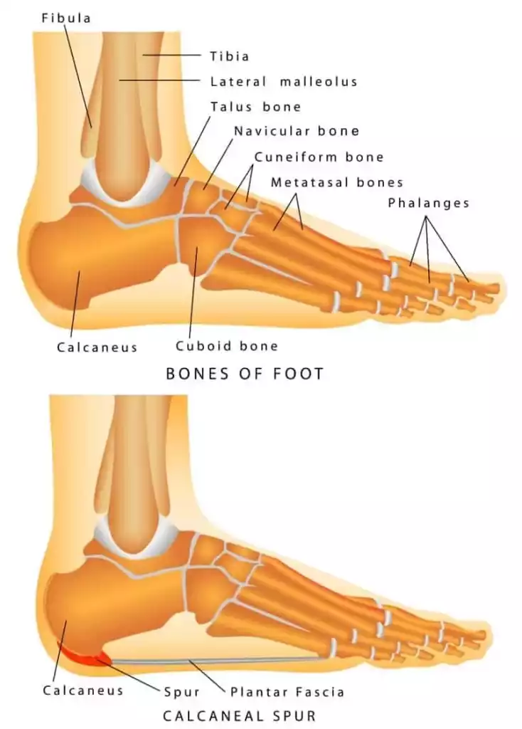 Bone Spur On Foot - Symptoms, Causes, and Treatment