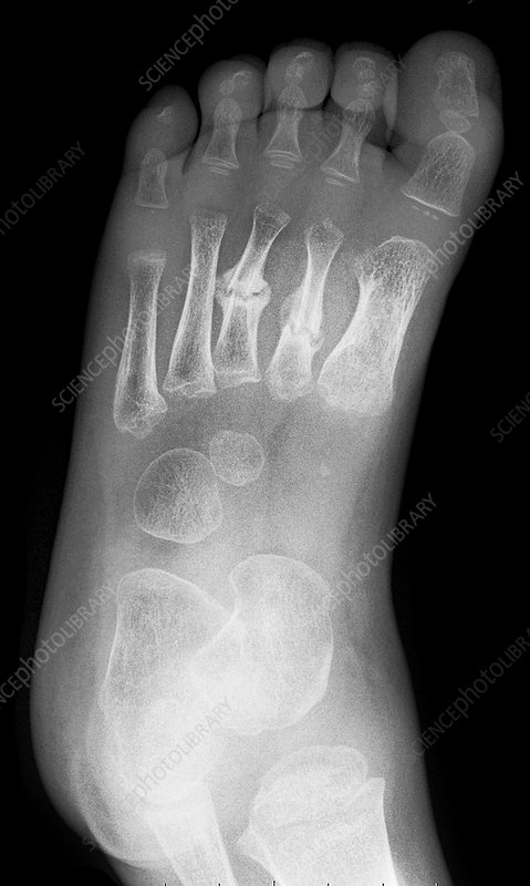 Fracture on Top of The Foot