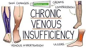 Chronic Venous Insufficiency: Symptoms, Causes, & Treatment